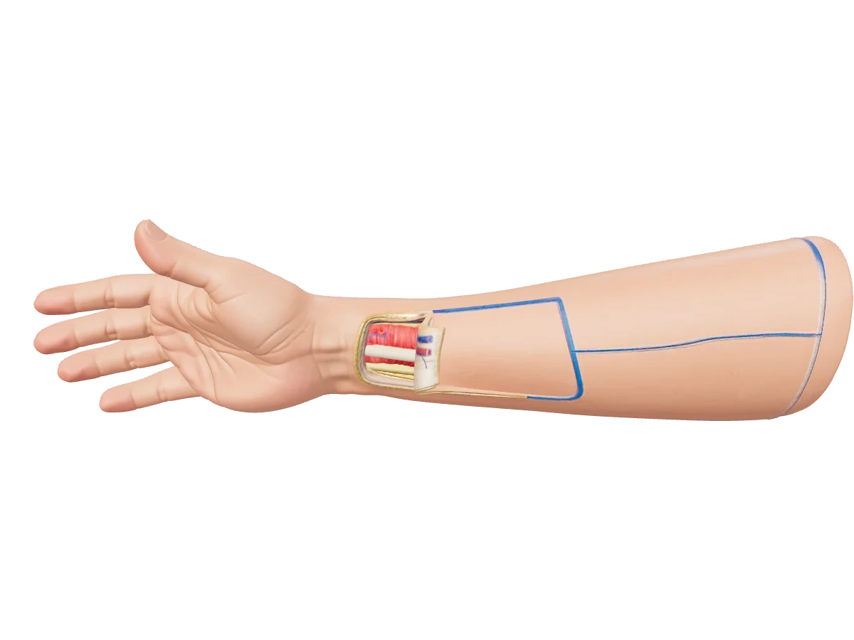 Radial forearm flap — 3D model
